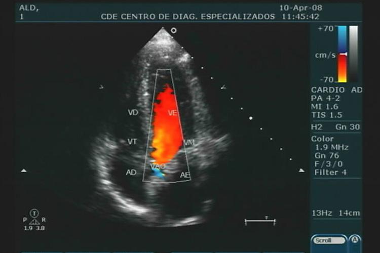 Ecocardiograma e com doppler colorido 